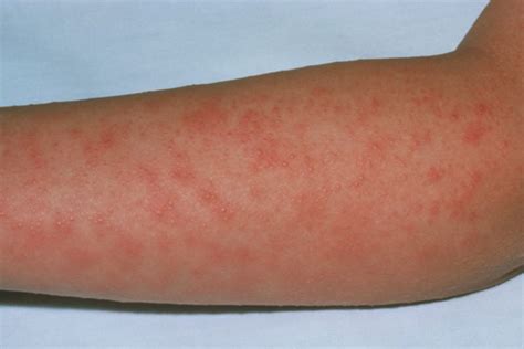 Derm Dx A Diffuse Erythematous Rash That Blanches With Pressure Clinical Advisor