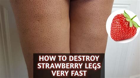 Treating Strawberry Leg Fastchizzy Charles Strawberry Legs Legs