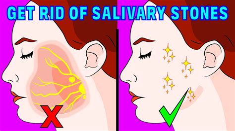 How To Get Rid Of Salivary Gland Stones Naturally Youtube