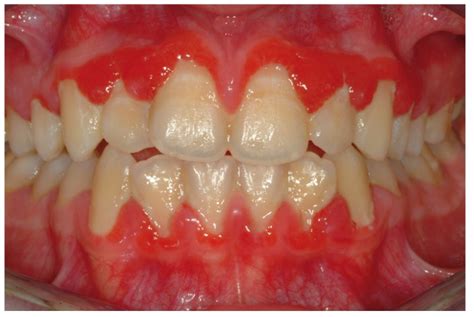 Clinical View Of A Diffuse Gingival Involvement In A Patients With A