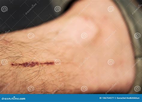 A Wound On The Human Body Suture Old Deep Cut Scar Close Up Stock