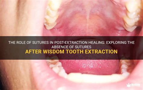 The Role Of Sutures In Post Extraction Healing Exploring The Absence