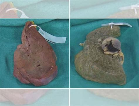 What A Liver Looks Like After Years Of Heavy Drinking