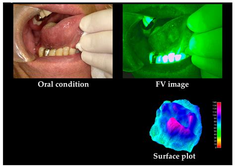 Cancers Free Full Text Non Invasive Early Detection Of Oral Cancers Using Fluorescence
