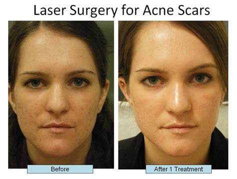 laser treatments for acne scars schweiger dermatology group