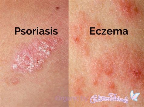 Many People Dont Know The Differences Between Psoriasis And Eczema