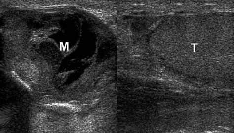 Testicular Hematoma Ultrasound Sexiz Pix