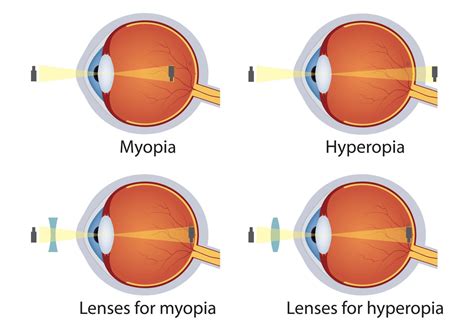 Hyperopia And Myopia Corrected By Lens Concept Of Eyes Defect