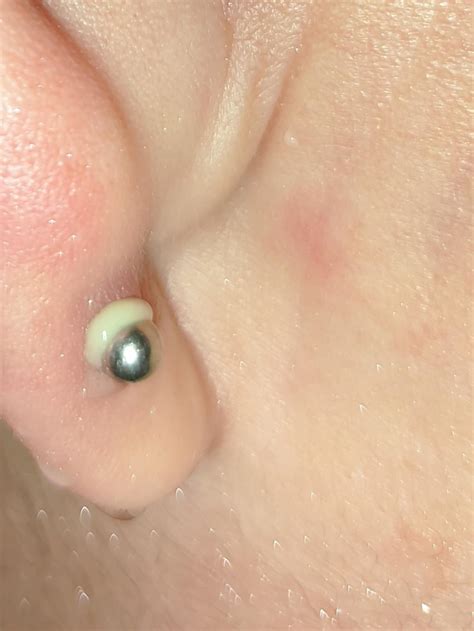 Any Advice On How To Treat Infected Piercing My Piercing Seems To Get Infected Once Per Month