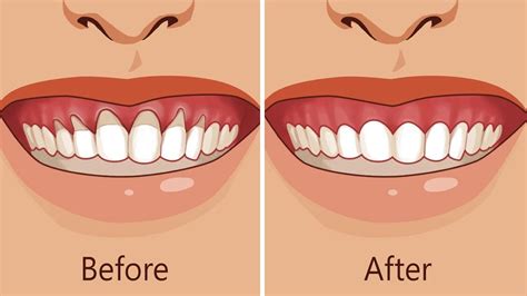Natural Ways To Stop And Heal Receding Gums Before Its Too Late Youtube