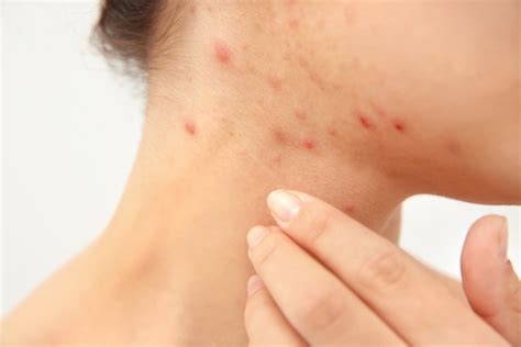 Neck Acne What It Means Treatment Prevention And More