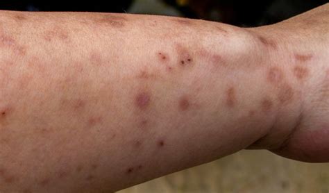 What Do Bed Bug Bites Look Like On Adults And Children Bed Bug Bites