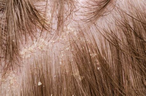 Dandruff Causes and Treatments