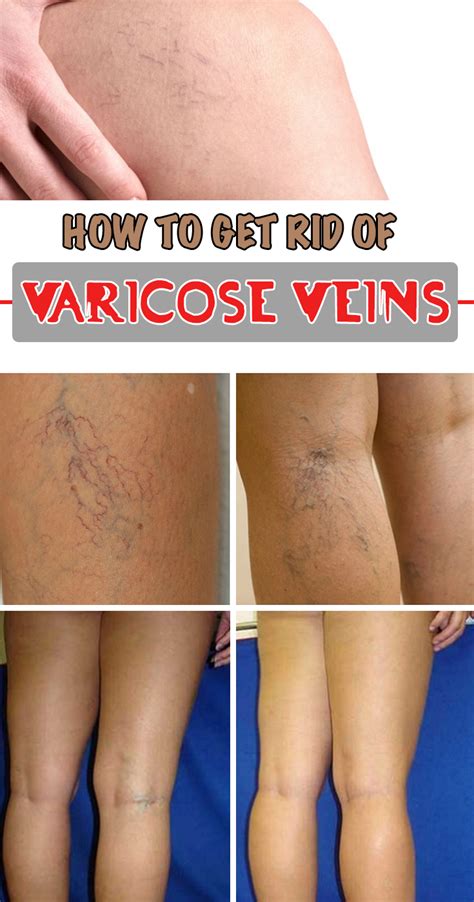 How To Get Rid Of Varicose Veins Wellness Alternative