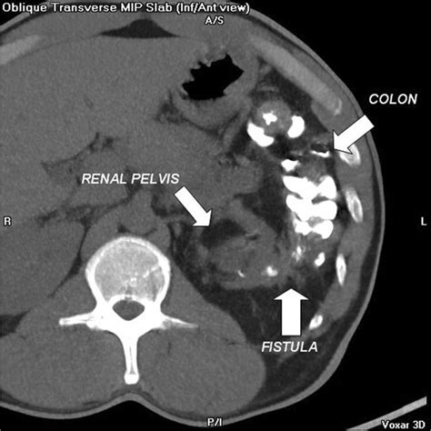 The Ct Scan With Barium Enema Shows The Connection Between The Left