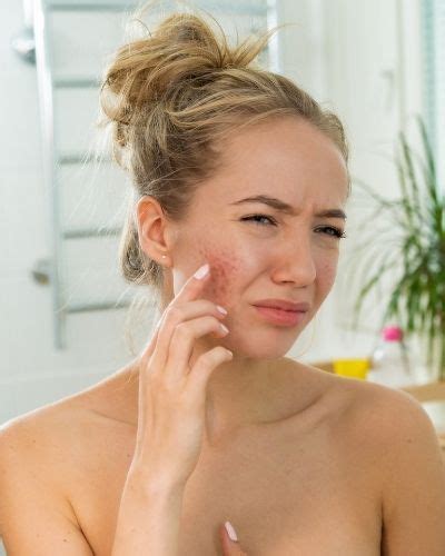 Is Tretinoin Good For Cystic Acne