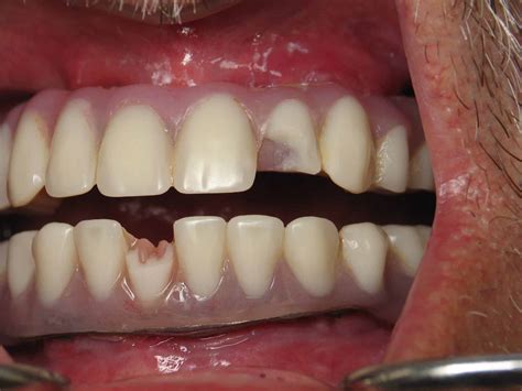 All On 4 Dental Implant Problems And Complications