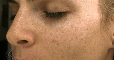 Useful Information Home Remedies For Age Spots On Face