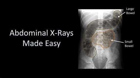 Abdominal X Rays Made Easy Youtube