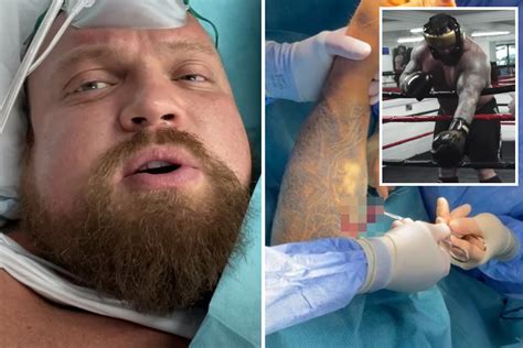 Eddie Hall Confirms He Suffered Detached Bicep And Has Undergone Surgery As Fight With Rival