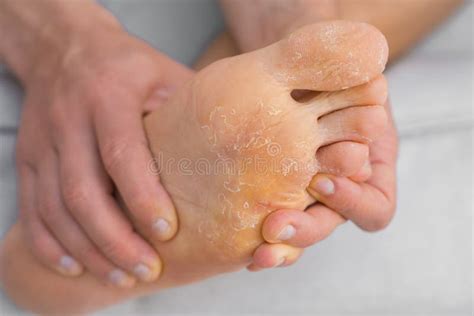 Psoriasis On The Men S Feet Treatment With Mud Stock Photo Image Of