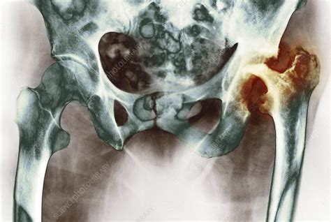 Osteoarthritis Of The Hip Joint X Ray Stock Image C0026998