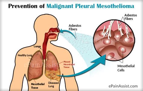 Malignant mesothelioma is a cancer that starts in cells in the linings of certain parts of the body, especially the chest or abdomen. Life Expectancy in Malignant Pleural Mesothelioma & its ...