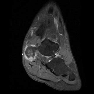 However, on mri images, no muscular abnormalities were detected. (PDF) Accessory navicular as a cause of medial foot pain:Evaluation with MRI