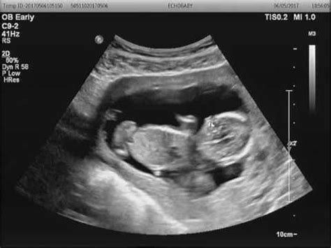 Binge watch my pregnancy videos. Baby ultrasound 14 weeks | Doovi