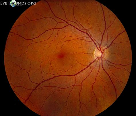 diabetic retinopathy  medical students eyeroundsorg