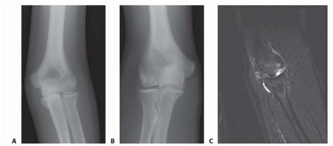 Types Of Cysts On Elbow