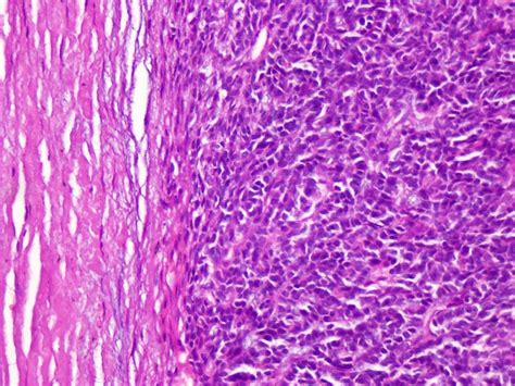 Basal Cell Adenoma Arising In The Submandibular Salivary Gland