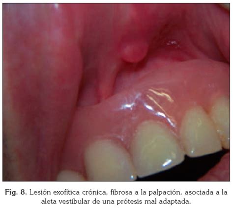 Lesiones Traum Ticas En La Mucosa Oral De Los Adultos Mayores