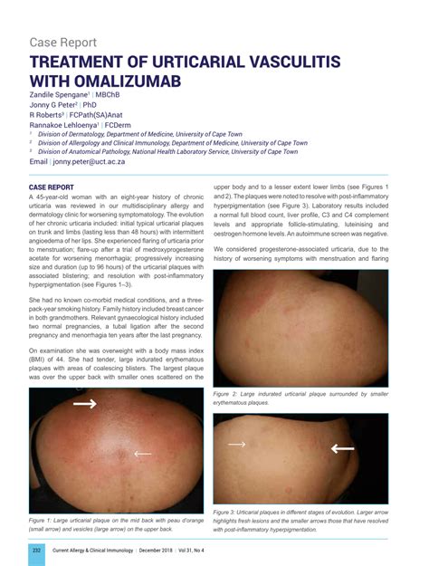 Pdf Treatment Of Urticarial Vasculitis With Omalizumab