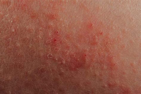 Síntomas Del Eccema Dermatitis Atópica Medicina Básica