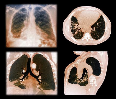 Kaposis Sarcoma Of The Lung Photograph By Zephyrscience Photo Library