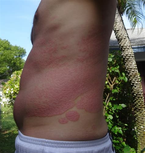 Cure Psoriasis Naturally At Home Dsc02810 A Warrior Curing Psoriasis
