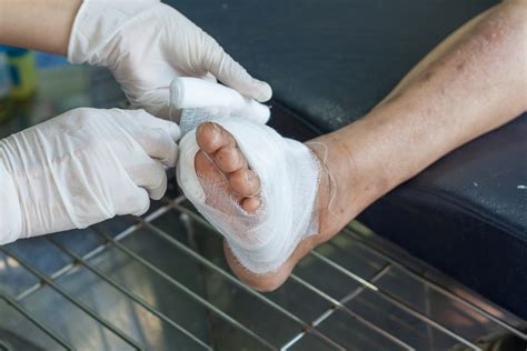 Treating Diabetic Necrotic Foot Ulcer