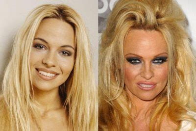 Pamela Anderson Plastic Surgery Obvious Lips Boob Job Plastic Surgery Talks