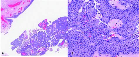 A Photomicrograph Showing Tumour Cells Which Display Round To Oval