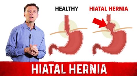 Hiatal Hernia The Best Home Treatment Sports Health And Wellbeing