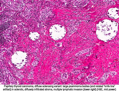 Pathology Outlines Papillary Thyroid Carcinoma Overview