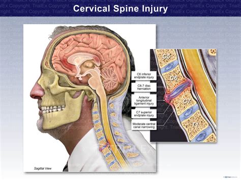 Cervical Spine Injury Trialexhibits Inc