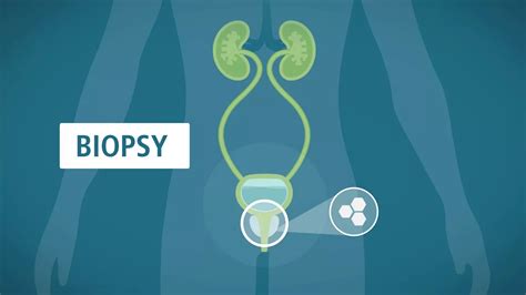Prostate Biopsy What You Should Know Department Of Urology