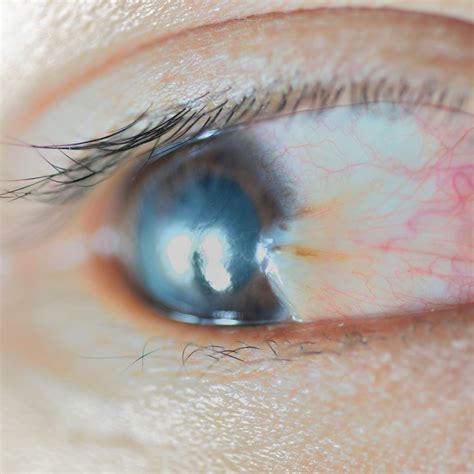 Bump On Eyeball Causes Symptoms And Treatment
