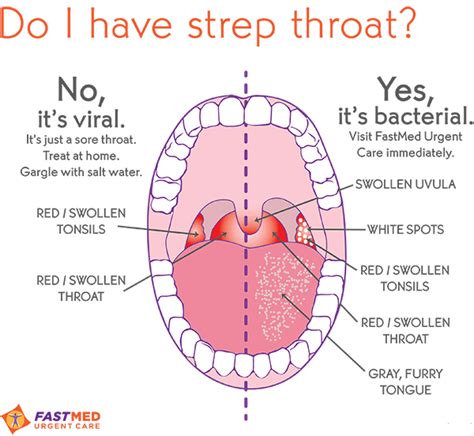 Strep Throat What It Looks Like Fastmed Urgent Care Sick Remedies