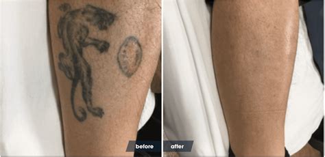 The Laser Tattoo Removal Healing Process Removery