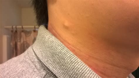 Is This Lump On My Neck A Lipoma Picture Dermatology Patient