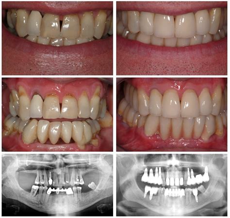 How Long Does A Dental Bridge Last Blog Advanced Dentistry
