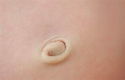 Belly Button Herniaumbilical Herniacausesandtreatment